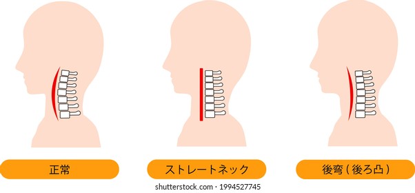 This is an illustration of a straight neck, cervical kyphosis, and normal neck bones. Japanese is normal and straight neck (text neck) and Posterior curvature (cervical kyphosis).