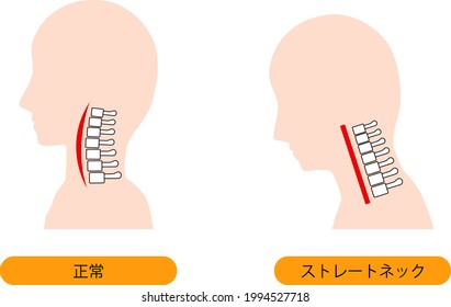 This is an illustration of a straight neck and a normal neck bone. Japanese is normal and straight neck (text neck).