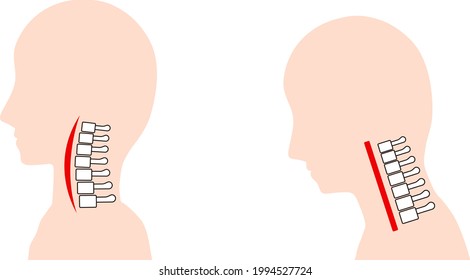 This Is An Illustration Of A Straight Neck (text Neck) And A Normal Neck Bone.