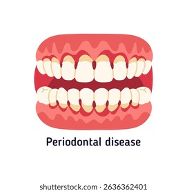 This picture shows periodontitis, bleeding gums, gum inflammation