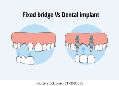 Thooth replacement whit a traditional bridge Vs dental implant