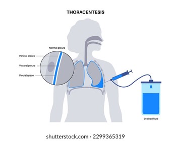 Thoracentesis procedure medical poster. Obtain fluid from space around the compressed lung. Incision of the chest wall. Unhealthy internal organs, respiratory system disease flat vector illustration