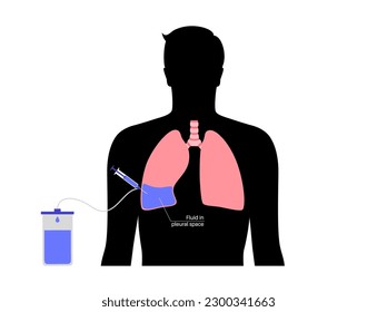 Afiche médico para el procedimiento de toracentesis. Obtener líquido del espacio alrededor del pulmón comprimido. Incisión de la pared del pecho. Órganos internos no sanos, enfermedad del sistema respiratorio ilustración vectorial plana