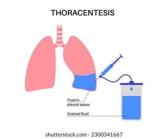 Thoracentesis procedure medical poster. Obtain fluid from space around the compressed lung. Incision of the chest wall. Unhealthy internal organs, respiratory system disease flat vector illustration