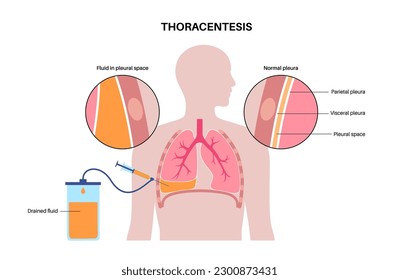 Thoracentesis procedure medical poster. Obtain fluid from space around the compressed lung. Incision of the chest wall. Unhealthy internal organs, respiratory system disease flat vector illustration