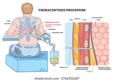 Thoracentesis procedure outline shows fluid removal from pleural space, patient seated, needle catheter enters between ribs to drain effusion into collection bag. Outline diagram