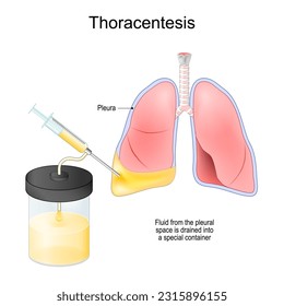 Thoracentesis. Thoracocentesis is an invasive medical procedure to remove fluid or air from the pleural space for diagnostic or therapy. Syringe, and Human lungs with Fluid. Medical vector poster.