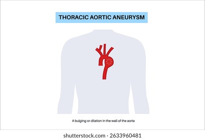 Thoraxaortenaneurysma im menschlichen Körper. Herzprobleme. Schmerzen, Bluthochdruck, Entzündungen an der Brust. Vergrößerter Brustkorbabschnitt. Medizinisches Diagramm, erweiterte Blutgefäße, flacher Vektor
