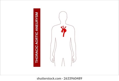 Aneurisma aórtico torácico en el cuerpo humano. Dolor, protuberancia o inflamación en el área del pecho. Sección agrandada de la aorta torácica. Diagrama médico con agrandamiento de los vasos sanguíneos Ilustración vectorial plana