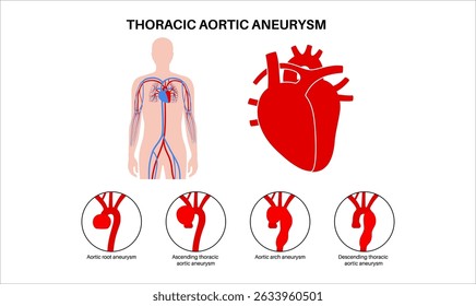 Aneurisma da aorta torácica no corpo humano. Problemas cardíacos. Dor, pressão, inflamação no peito. Seção aumentada da aorta torácica. Diagrama médico, ilustração de vetor de vasos sanguíneos dilatados