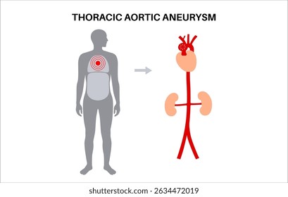 Thoraxaortenaneurysma im menschlichen Körper. Herzprobleme. Schmerzen, Bluthochdruck, Entzündungen an der Brust. Vergrößerter Brustkorbabschnitt. Medizinisches Diagramm, erweiterte Blutgefäße, flacher Vektor