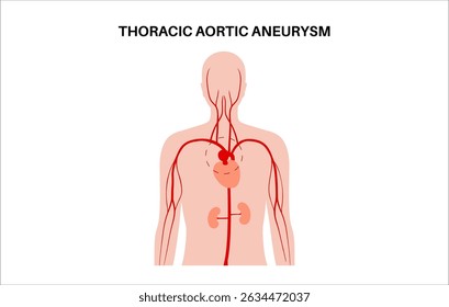 Thoracic aortic aneurysm in the human body. Heart problems. Pain, high blood pressure, inflammation on the chest. Enlarged section of thoracic aorta. Medical diagram, dilated blood vessels flat vector