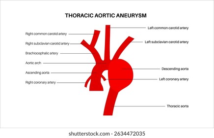 Infografik zum Aortenaneurysma. Herzprobleme. Schmerzen, Überdruck, Entzündung der Brust. Vergrößerter Brustkorbabschnitt. Medizinisches Diagramm, erweiterte Blutgefäße, Vektorgrafik