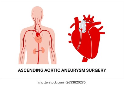 Cirurgia aberta de aneurisma da aorta torácica. O cirurgião repara ou substitui o segmento aórtico aumentado por enxerto sintético. Procedimento cardiovascular, reparo aórtico, operação hospitalar vetor ilustração médica