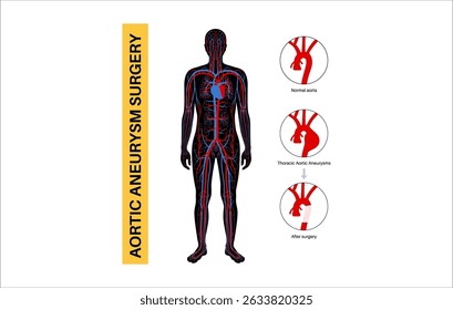Thoraxaortenaneurysma offene Operation. Chirurg repariert oder ersetzt vergrößertes Aortensegment durch synthetisches Transplantat. Herz-Kreislauf-Verfahren, Aortenreparatur, Krankenhausoperation, medizinische Vektorgrafik