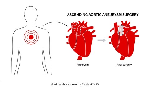 Thoraxaortenaneurysma offene Operation. Chirurg repariert oder ersetzt vergrößertes Aortensegment durch synthetisches Transplantat. Herz-Kreislauf-Verfahren, Aortenreparatur, Krankenhausoperation, medizinische Vektorgrafik