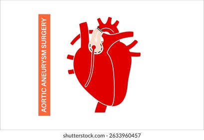Thoraxaortenaneurysma offene Operation. Chirurg repariert oder ersetzt vergrößertes Aortensegment durch synthetisches Transplantat. Herz-Kreislauf-Verfahren, Aortenreparatur, Krankenhausoperation, medizinische Vektorgrafik