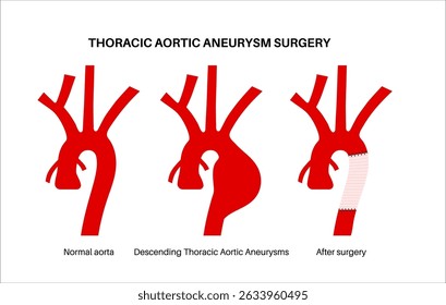 Thoraxaortenaneurysma offene Operation. Chirurg repariert oder ersetzt vergrößertes Aortensegment durch synthetisches Transplantat. Herz-Kreislauf-Verfahren, Aortenreparatur, Krankenhausoperation, medizinische Vektorgrafik