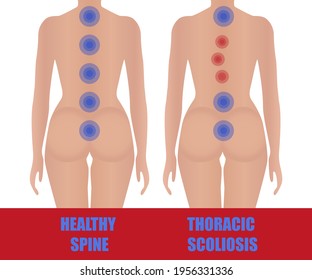 Thoracic scoliosis. Curvature of the spine. Image of the girl's uneven back. Comparisons with a healthy back. Medical educational poster.