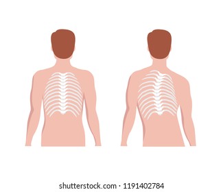 Thoracic Scoliosis on the thoracic spine and straight backbone concept vector illustration in flat design isolated on white background. Scoliosis medical infographic elements, male silhouette