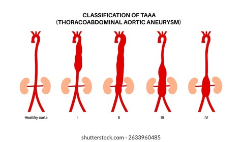 Cartel de clasificación de aneurisma aórtico toracoabdominal. Extensión del aneurisma a lo largo de la aorta torácica y abdominal. Diferente enfoque quirúrgico y evaluación de riesgos, ilustración médica de Vector plano