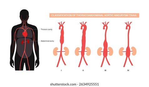 Cartel de clasificación de aneurisma aórtico toracoabdominal. Extensión del aneurisma a lo largo de la aorta torácica y abdominal. Diferente enfoque quirúrgico y evaluación de riesgos, ilustración médica de Vector plano