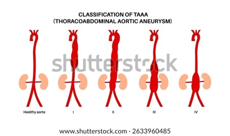 Thoracoabdominal aortic aneurysm classification poster. Extent of the aneurysm along the thoracic and abdominal aorta. DIfferent surgical approach and assess risks, flat vector medical illustration