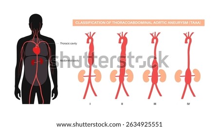 Thoracoabdominal aortic aneurysm classification poster. Extent of the aneurysm along the thoracic and abdominal aorta. DIfferent surgical approach and assess risks, flat vector medical illustration