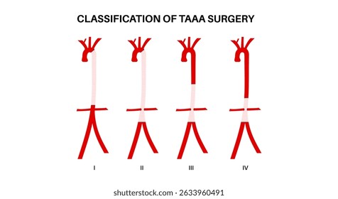 Thoracoabdominal aortic aneurysm surgery classification. Extent of the aneurysm along the thoracic and abdominal aorta. DIfferent surgical approach and assess risks, flat vector medical illustration