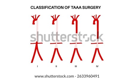Thoracoabdominal aortic aneurysm surgery classification. Extent of the aneurysm along the thoracic and abdominal aorta. DIfferent surgical approach and assess risks, flat vector medical illustration