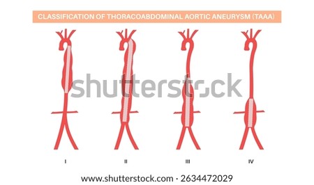 Thoracoabdominal aortic aneurysm surgery classification. Extent of the aneurysm along the thoracic and abdominal aorta. DIfferent surgical approach and assess risks, flat vector medical illustration