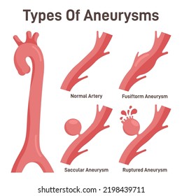 Thoracoabdominal Aortic Aneurysms Types Healthy Aorta Stock Vector ...