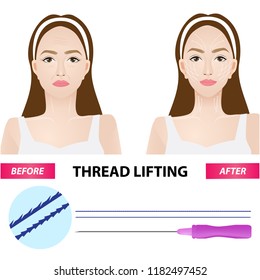 Thread lifting vector illustration