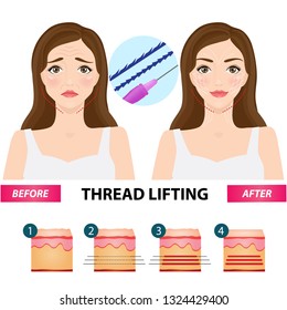 Thread lifting vector illustration