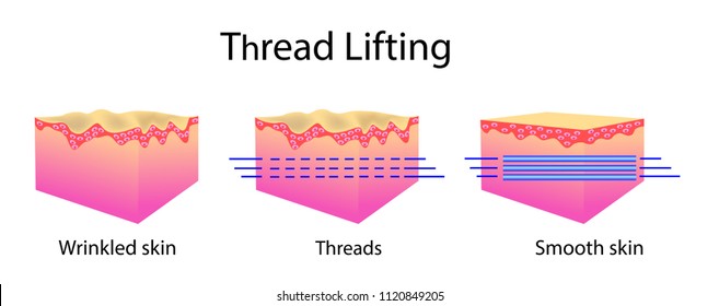 Thread lifting, vector illustration and skin cells, before after effect