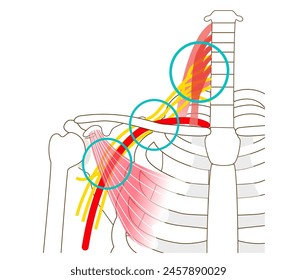 Three gaps that cause thoracic outlet syndrome