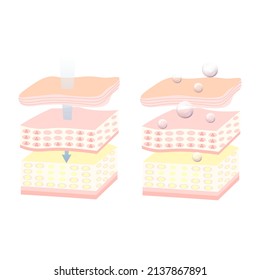 Three main layer of the human skin. Illustration about medical diagram.