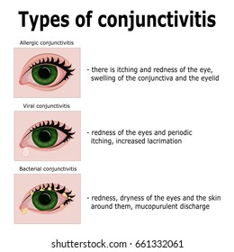 20,540 Conjunctivitis Images, Stock Photos & Vectors | Shutterstock