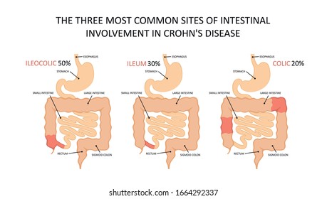 Tres lugares intestinales más comunes 
participación en la enfermedad de crohn