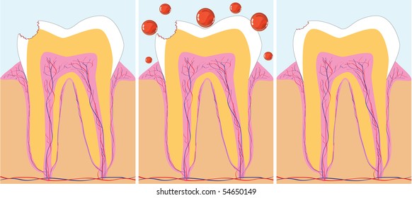 Three phase of caries treatment, vector illustration