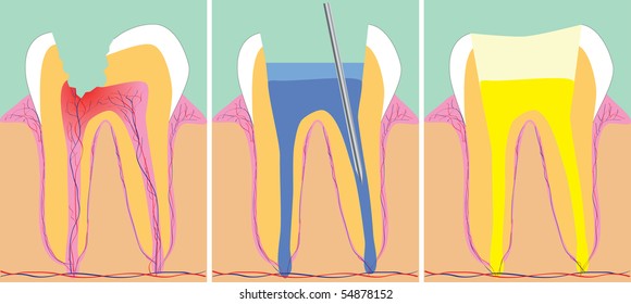 Three phase of tooth fillings, vector illustration