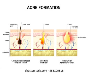 347 Acne formation Images, Stock Photos & Vectors | Shutterstock