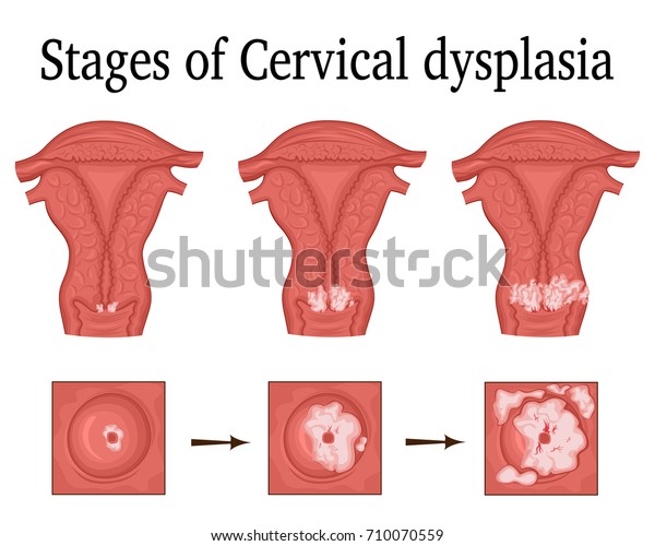 The three stages of cervical dysplasia - a\
potential premalignant\
condition