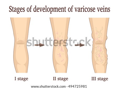 Three stages of the development of varicose veins isolated on white background