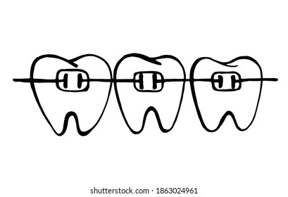 Three teeth with braces. Bracket system. Black and white hand-drawn image isolated on white background.