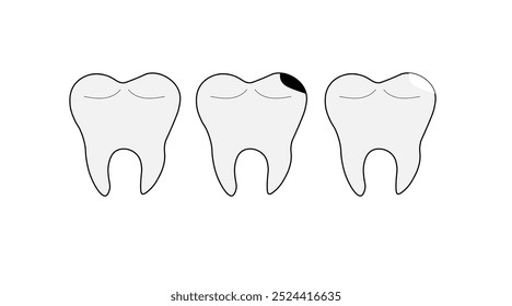 três dentes conjunto de cáries saudáveis e com um enchimento em um fundo branco