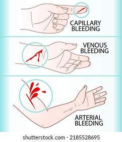 Drei Arten von Blutungen. Medizinische Infografik, Illustration zur Gesundheitsversorgung. Vektorgrafik. 