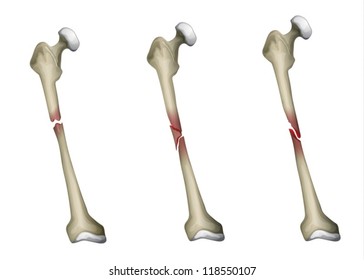Three types of bone fracture in the femur