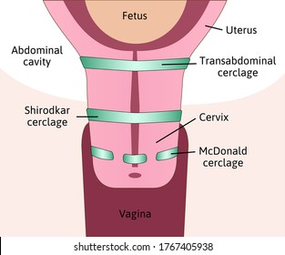 Abdominal Cerclage Vs Cervical Cerclage