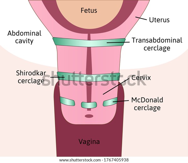 three types of Cervical cerclage or
cervical stitch,  treatment for cervical weakness. Transabdominal,
Shirodkar and McDonald cerclage. Fetus in womb, uterus. Colored
medical vector
illustration.